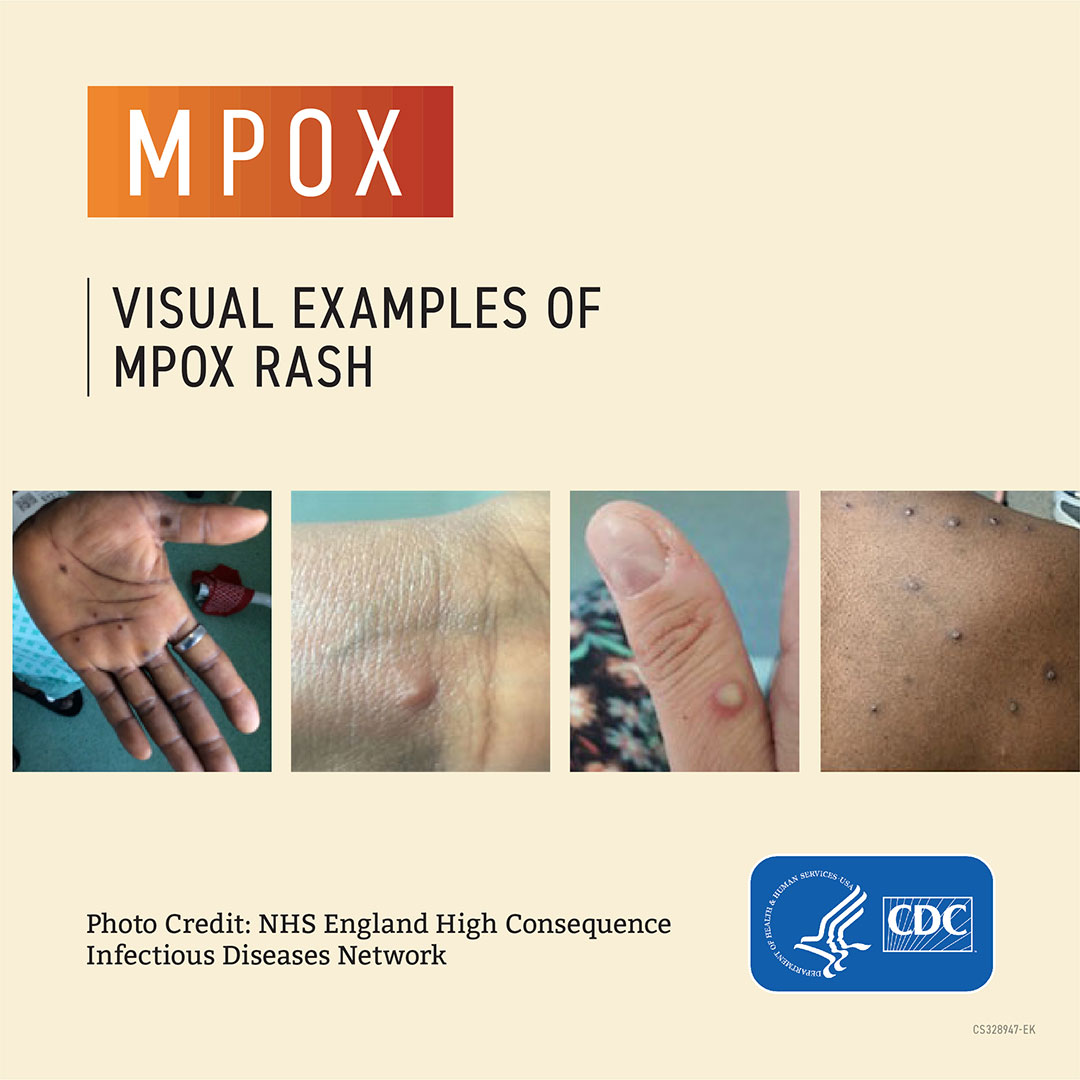 Mpox examples